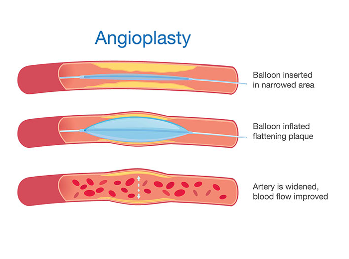 Angioplasty