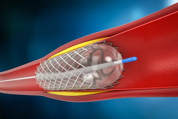 Angioplasty