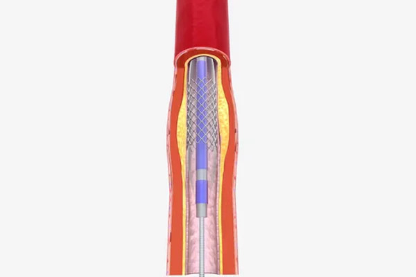 Peripheral Interventions