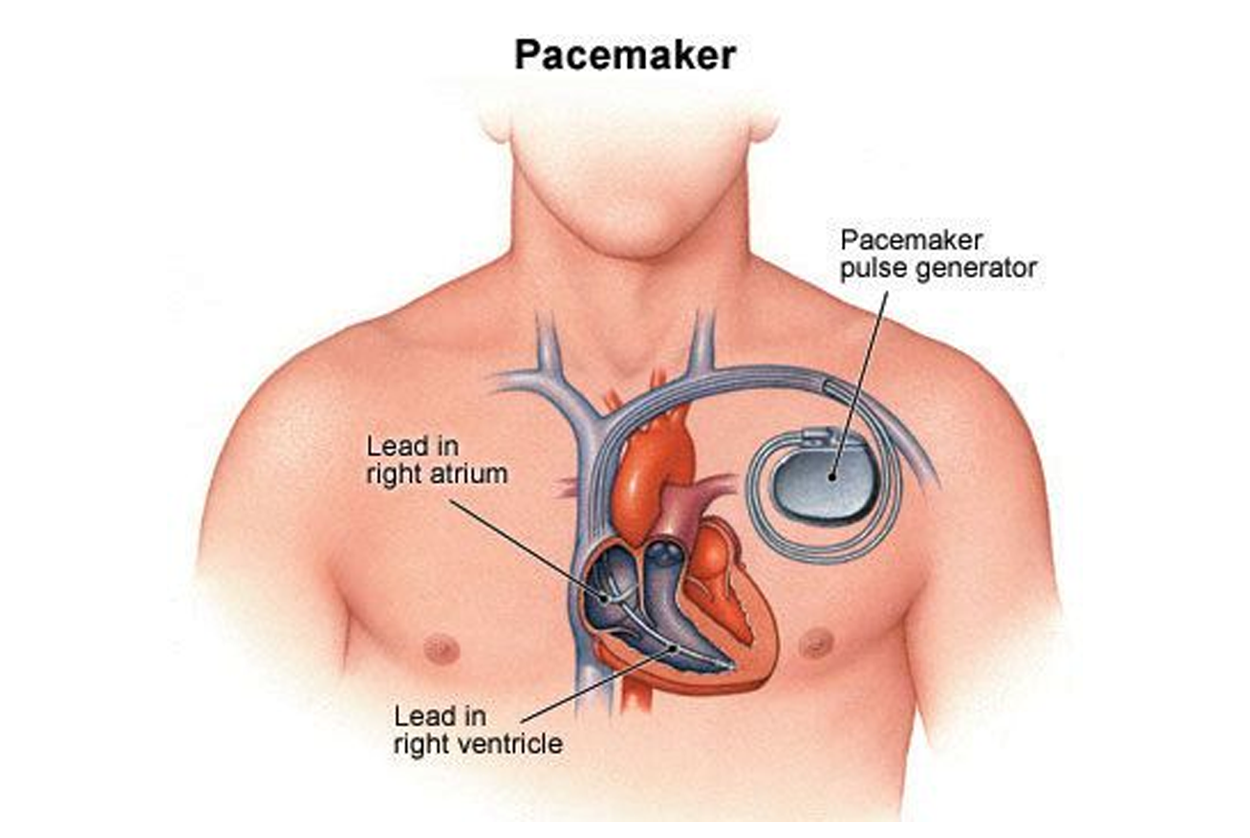 Pacemakers