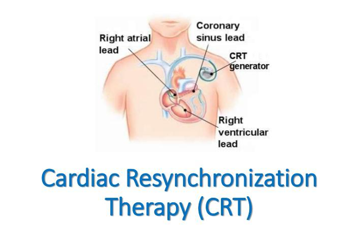 Cardiac Device Implantation