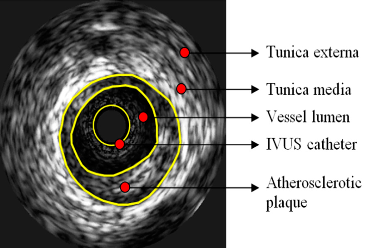 Intravascular Ultrasound