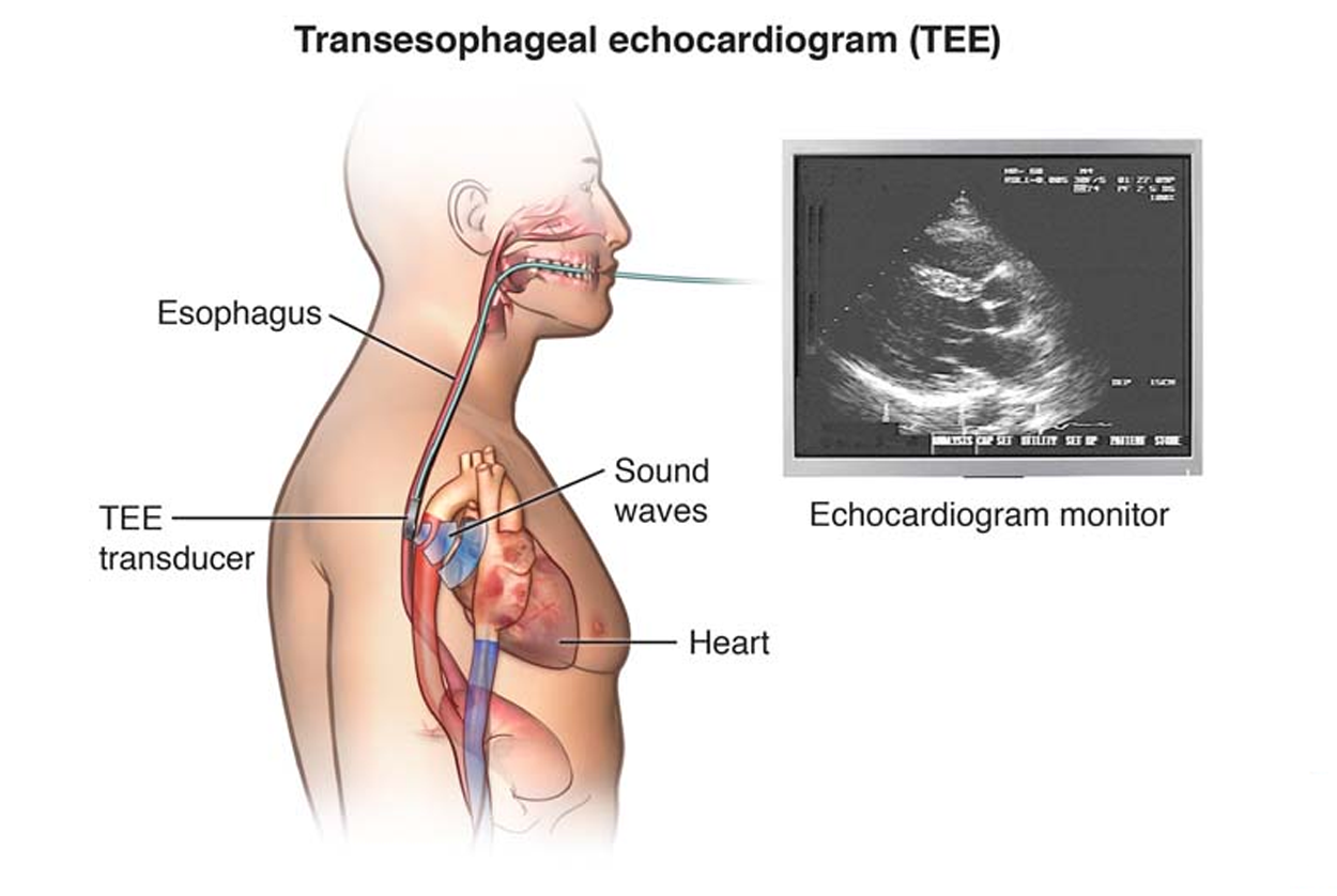 ECHO Transthoracic / Transesophageal / Stress ECHO