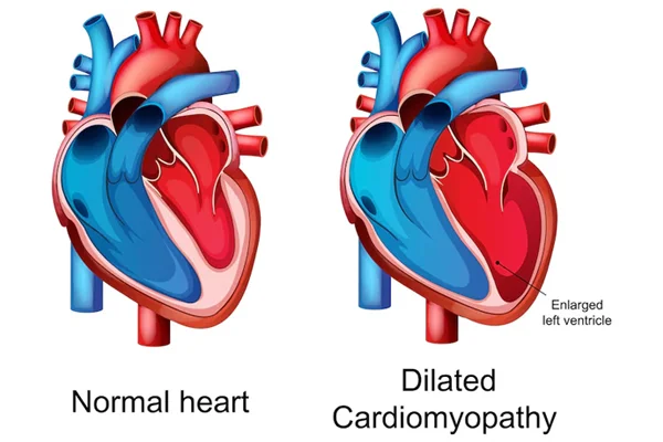 Left Main Disease