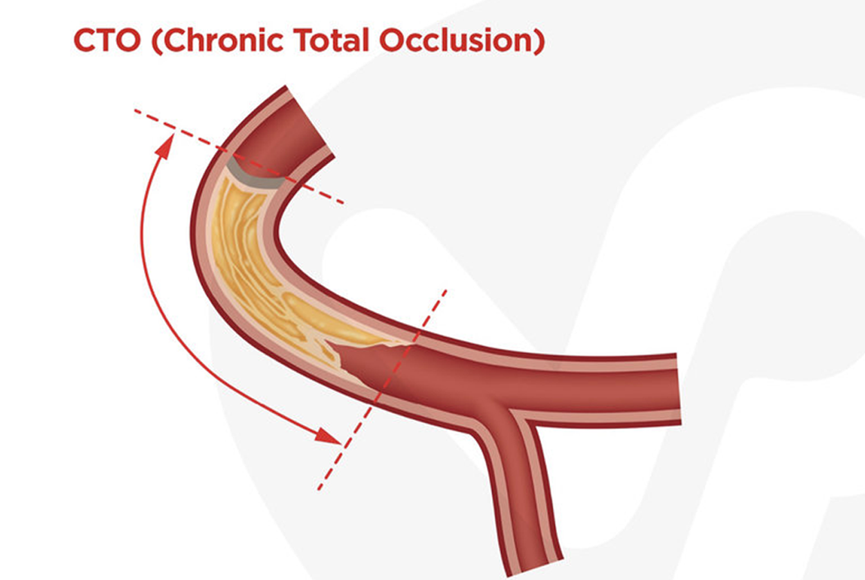 Chronic Total Occlusion (OCT)